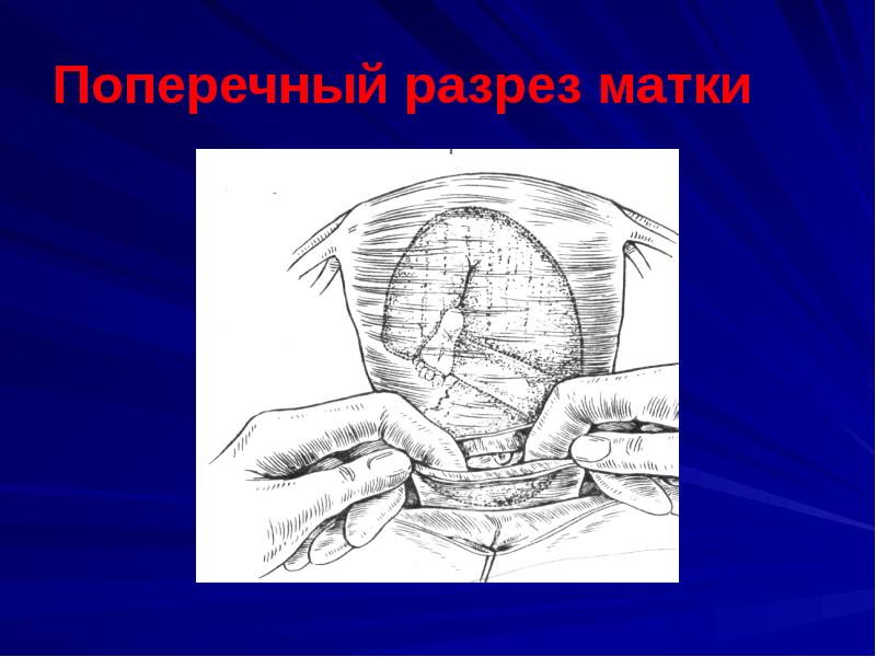 Кесарево сечение в современном акушерстве презентация