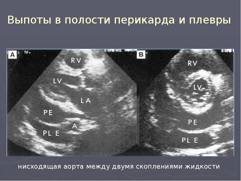 Жидкость в перикарде. Выпот в полости перикарда. Плевральный выпот ЭХОКГ. Жидкость в плевральной полости на ЭХОКГ.