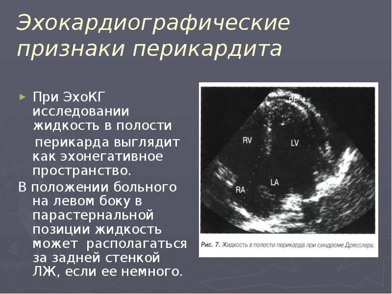 Характеристика эхонегативного изображения