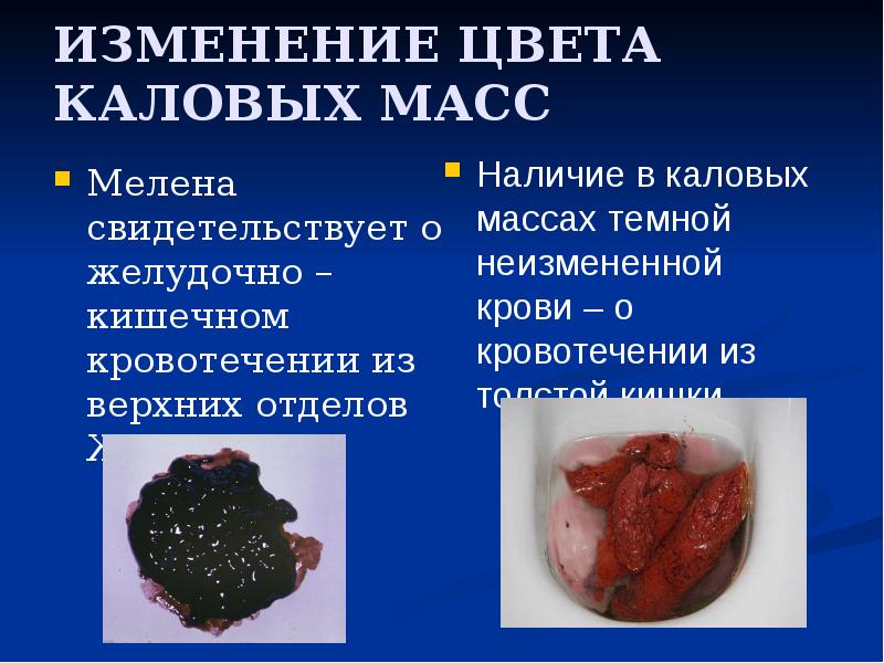 ИЗМЕНЕНИЕ ЦВЕТА КАЛОВЫХ МАСС
Мелена свидетельствует о желудочно – кишечном кровотечении ИЗМЕНЕНИЕ ЦВЕТА КАЛОВЫХ МАСС
Мелена свидетельствует о желудочно – кишечном кровотечении