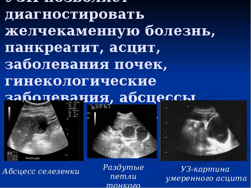 УЗИ позволяет диагностировать желчекаменную болезнь, панкреатит, асцит, заболевания почек, гинекологические заболевания, УЗИ позволяет диагностировать желчекаменную болезнь, панкреатит, асцит, заболевания почек, гинекологические заболевания,