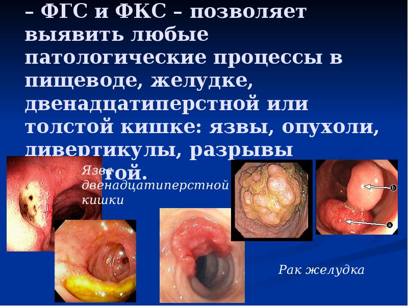 Эндоскопическое исследование – ФГС и ФКС – позволяет выявить любые патологические Эндоскопическое исследование – ФГС и ФКС – позволяет выявить любые патологические