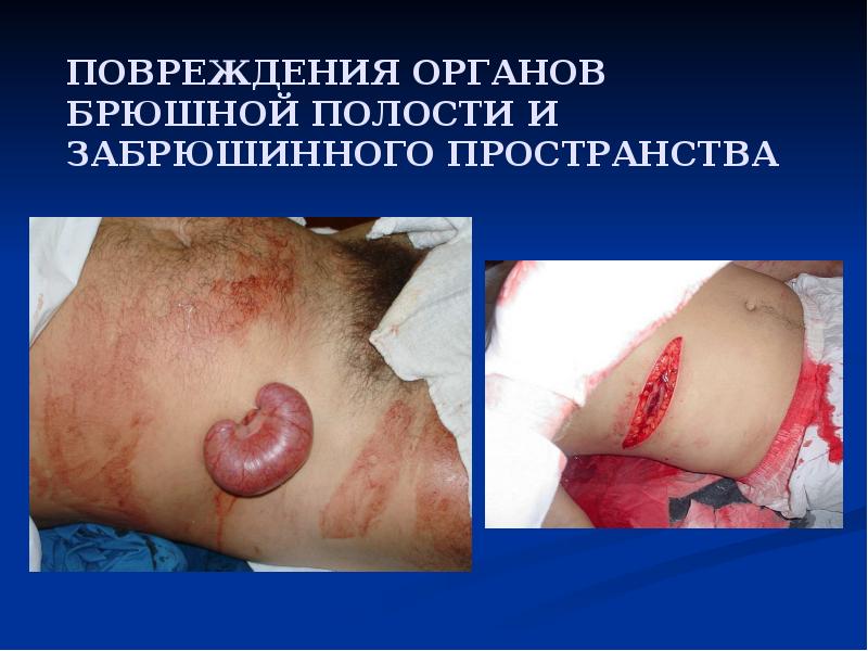 ПОВРЕЖДЕНИЯ ОРГАНОВ БРЮШНОЙ ПОЛОСТИ И ЗАБРЮШИННОГО ПРОСТРАНСТВА ПОВРЕЖДЕНИЯ ОРГАНОВ БРЮШНОЙ ПОЛОСТИ И ЗАБРЮШИННОГО ПРОСТРАНСТВА