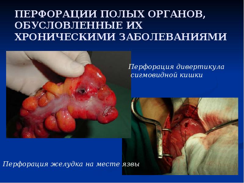 ПЕРФОРАЦИИ ПОЛЫХ ОРГАНОВ, ОБУСЛОВЛЕННЫЕ ИХ ХРОНИЧЕСКИМИ ЗАБОЛЕВАНИЯМИ ПЕРФОРАЦИИ ПОЛЫХ ОРГАНОВ, ОБУСЛОВЛЕННЫЕ ИХ ХРОНИЧЕСКИМИ ЗАБОЛЕВАНИЯМИ