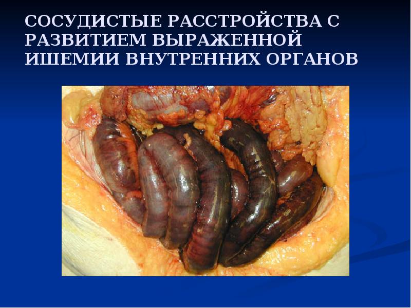 СОСУДИСТЫЕ РАССТРОЙСТВА С РАЗВИТИЕМ ВЫРАЖЕННОЙ ИШЕМИИ ВНУТРЕННИХ ОРГАНОВ СОСУДИСТЫЕ РАССТРОЙСТВА С РАЗВИТИЕМ ВЫРАЖЕННОЙ ИШЕМИИ ВНУТРЕННИХ ОРГАНОВ