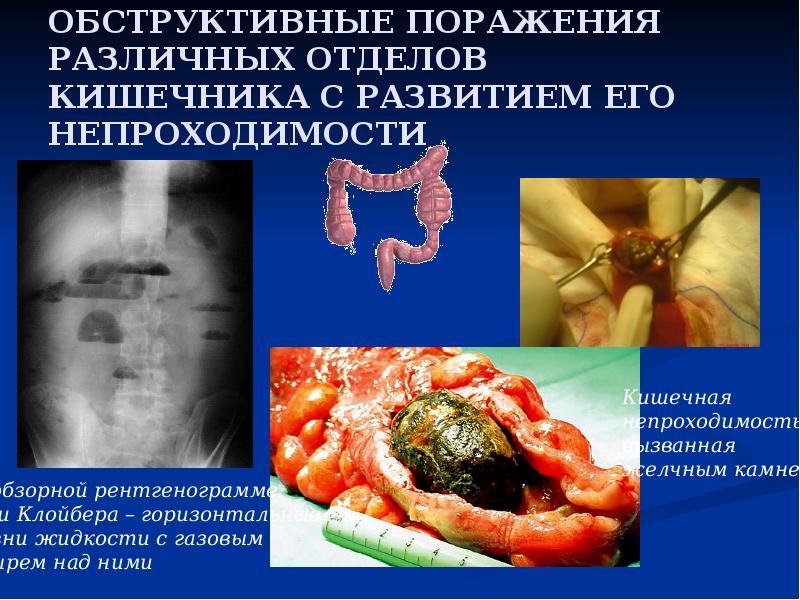 ОБСТРУКТИВНЫЕ ПОРАЖЕНИЯ РАЗЛИЧНЫХ ОТДЕЛОВ КИШЕЧНИКА С РАЗВИТИЕМ ЕГО НЕПРОХОДИМОСТИ ОБСТРУКТИВНЫЕ ПОРАЖЕНИЯ РАЗЛИЧНЫХ ОТДЕЛОВ КИШЕЧНИКА С РАЗВИТИЕМ ЕГО НЕПРОХОДИМОСТИ