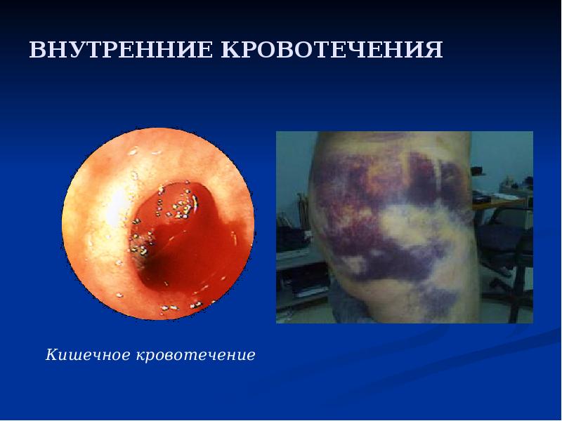 ВНУТРЕННИЕ КРОВОТЕЧЕНИЯ ВНУТРЕННИЕ КРОВОТЕЧЕНИЯ