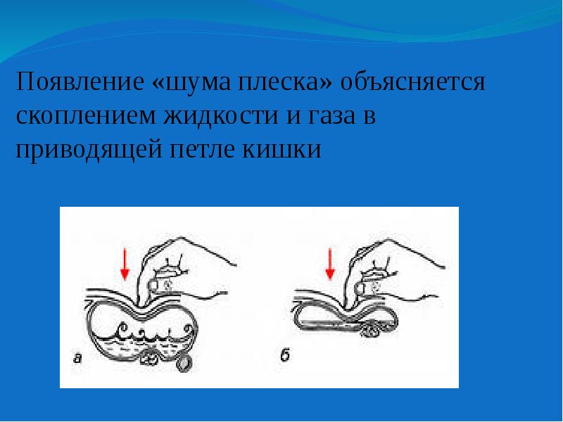 Появляется шум. Шум плеска в животе. Симптом шума плеска в желудке. Шум плеска при кишечной непроходимости. Шум плеска при пальпации.