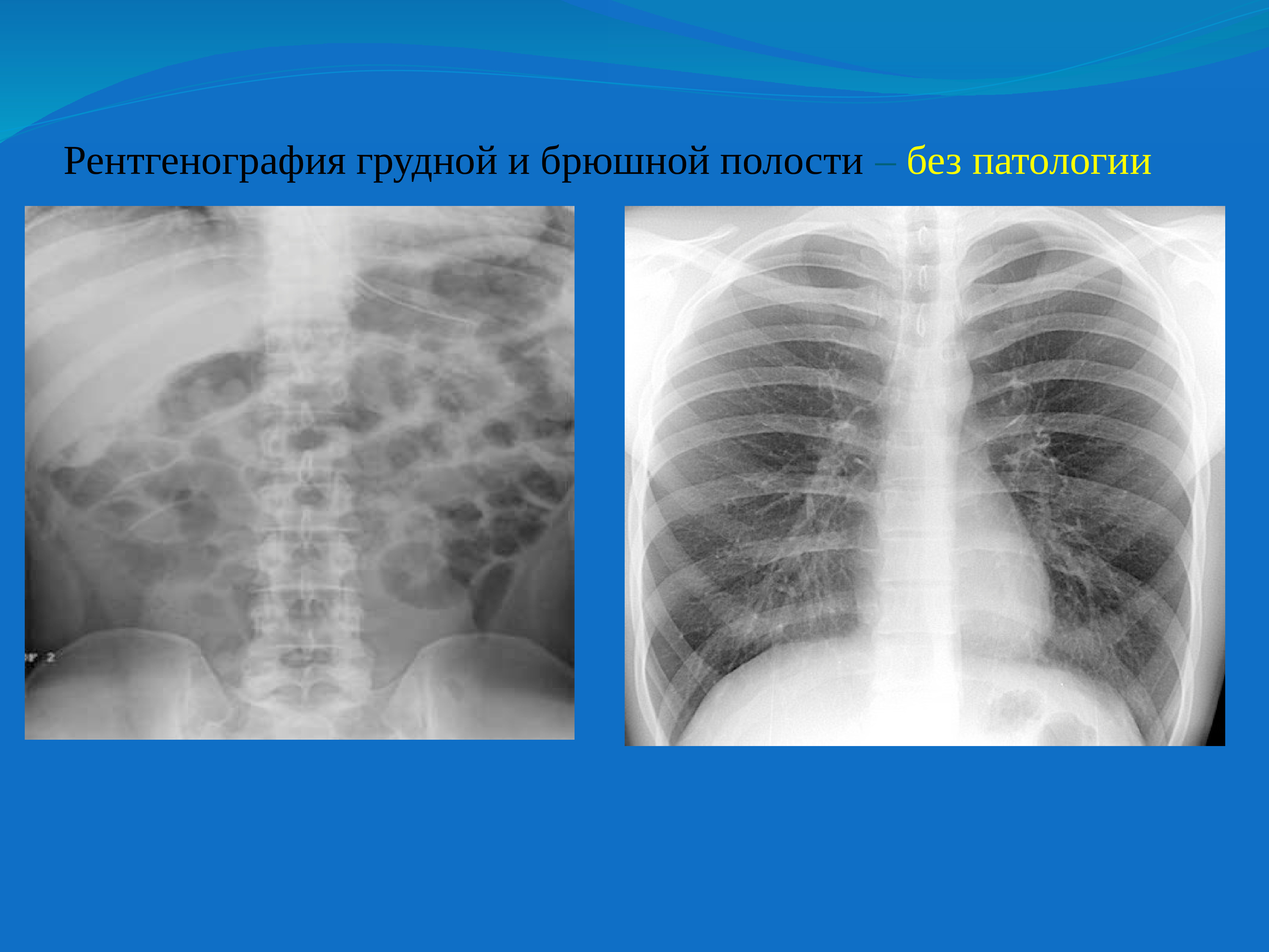 Пневматизация. Обзорная рентгенография грудной клетки норма. Обзорная рентгенограмма органов грудной клетки в норме. Обзорный рентген органов грудной клетки. Обзорная рентгенография легких норма.