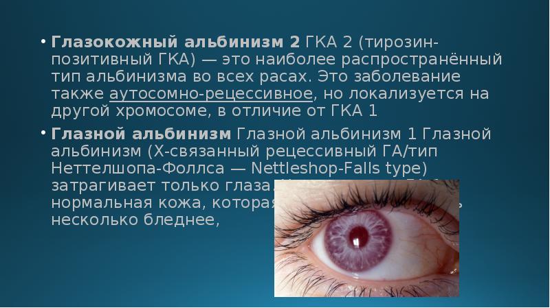 Глазокожный альбинизм 2 ГКА 2 (тирозин-позитивный ГКА) — это наиболее распространённый тип альбинизма Глазокожный альбинизм 2 ГКА 2 (тирозин-позитивный ГКА) — это наиболее распространённый тип альбинизма