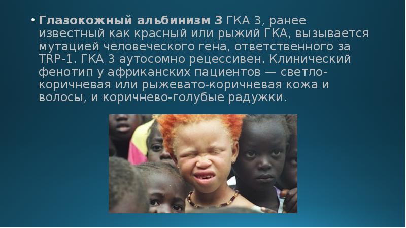 Глазокожный альбинизм 3 ГКА 3, ранее известный как красный или рыжий ГКА, Глазокожный альбинизм 3 ГКА 3, ранее известный как красный или рыжий ГКА,
