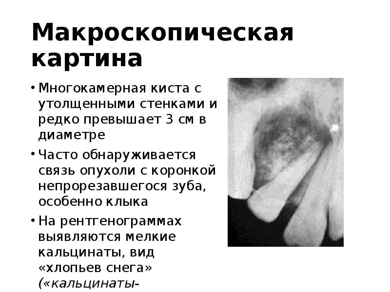 Макроскопическая картина
Многокамерная киста с утолщенными стенками и редко превышает 3 Макроскопическая картина
Многокамерная киста с утолщенными стенками и редко превышает 3
