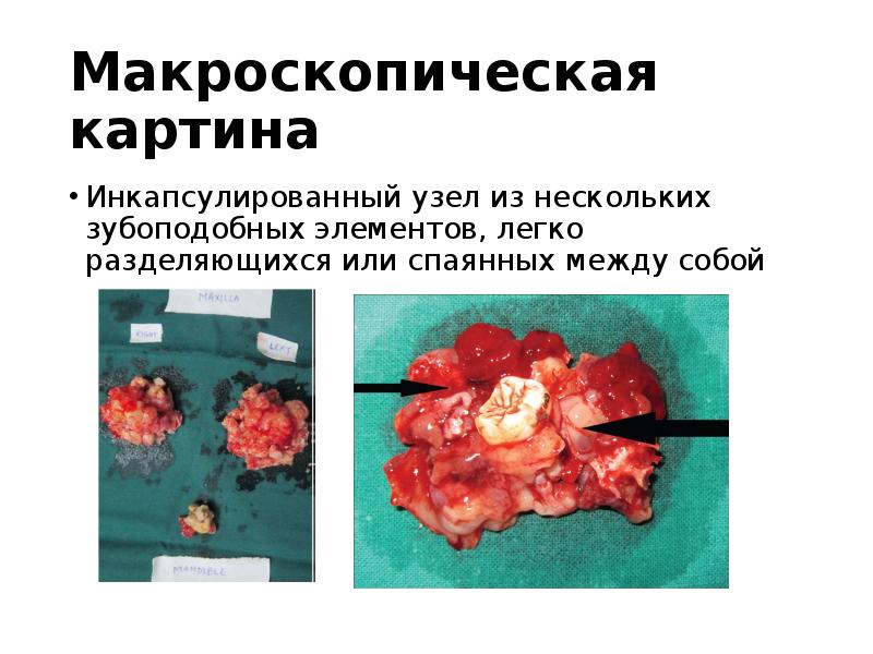 Макроскопическая картина
Инкапсулированный узел из нескольких зубоподобных элементов, легко разделяющихся или Макроскопическая картина
Инкапсулированный узел из нескольких зубоподобных элементов, легко разделяющихся или