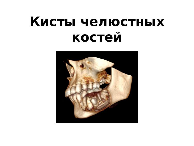 Кисты челюстных костей Кисты челюстных костей