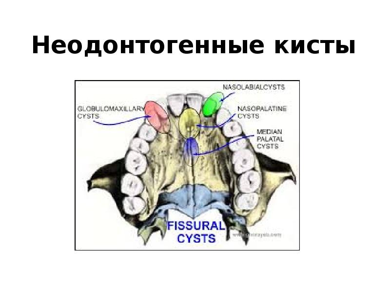 Неодонтогенные кисты Неодонтогенные кисты