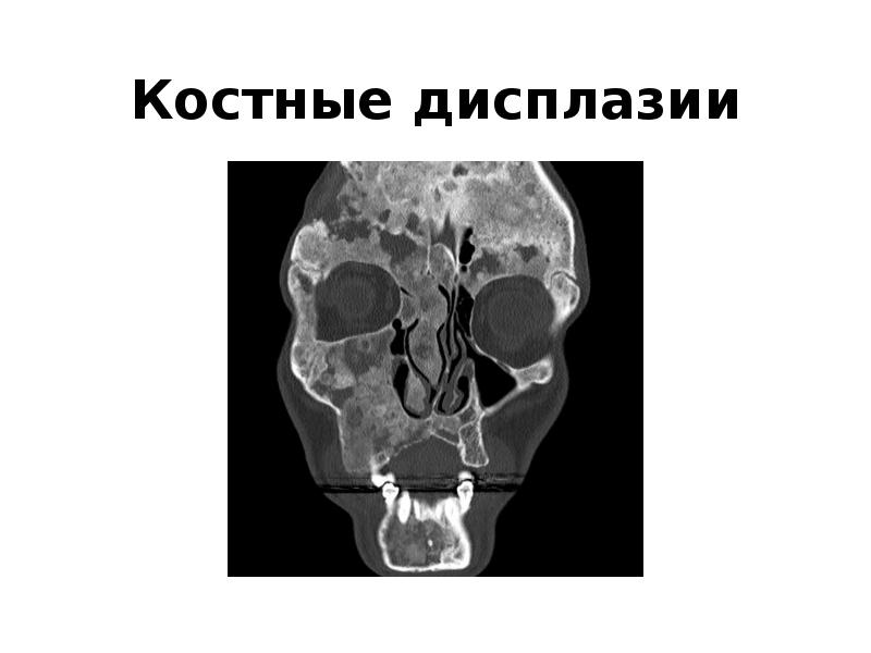 Костные дисплазии Костные дисплазии
