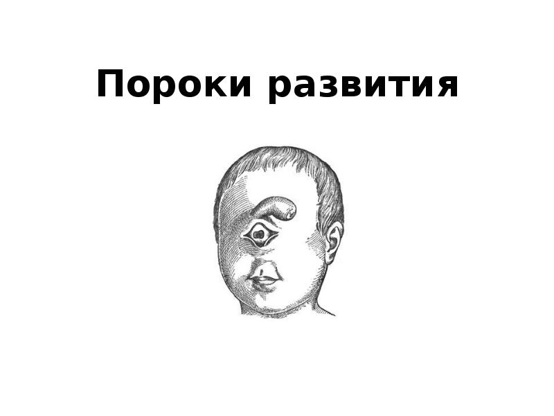 Пороки развития Пороки развития