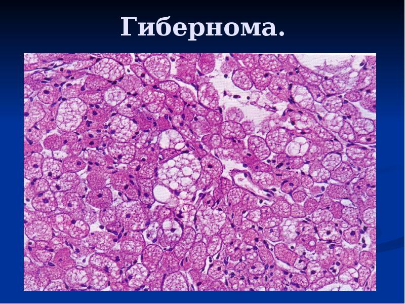 Мезенхимальные опухоли патанатомия презентация