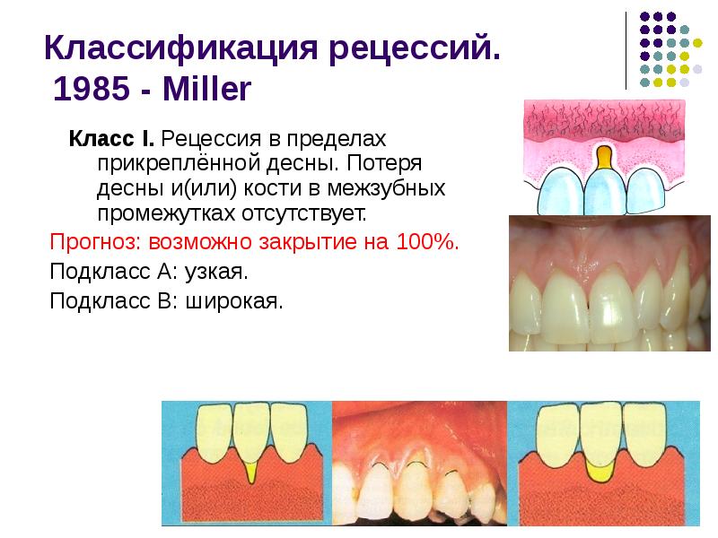 Подвижность зубов презентация