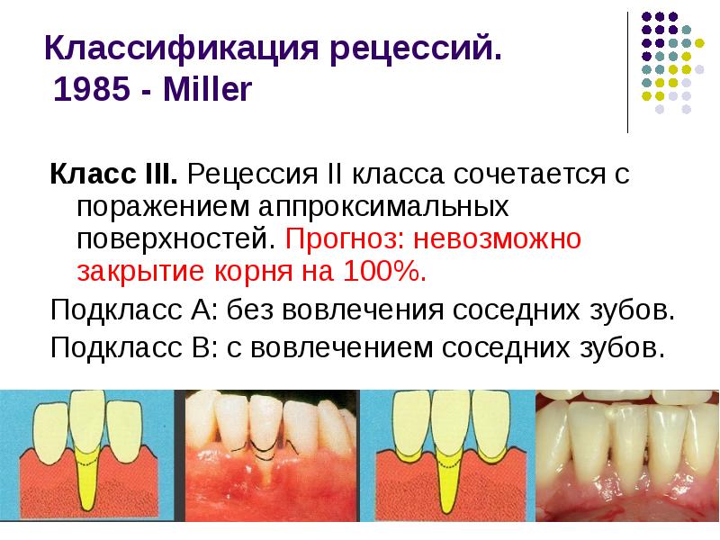 Подвижность зубов презентация