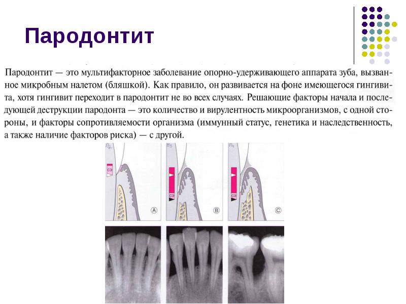 Классификация заболеваний пародонта презентация