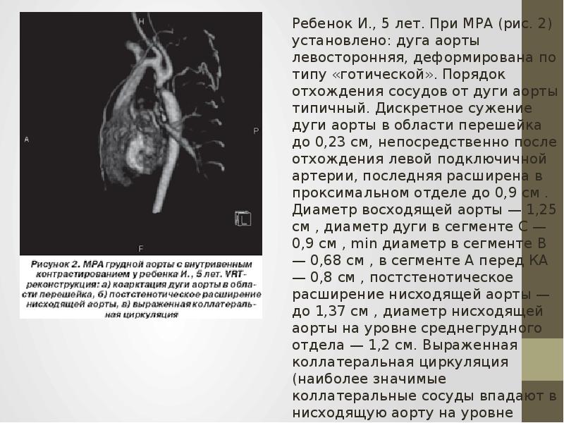 Расширение аорты сердца