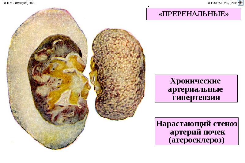 Патофизиология почек презентация