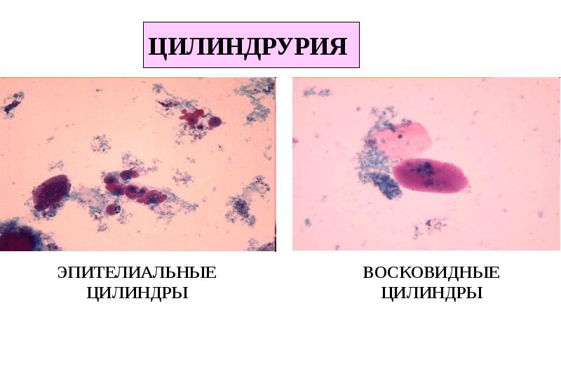 Цилиндрурия характерна. Цилиндрурия. Цилиндрурия в моче. Цилиндрурия патофизиология. Истинная цилиндрурия.