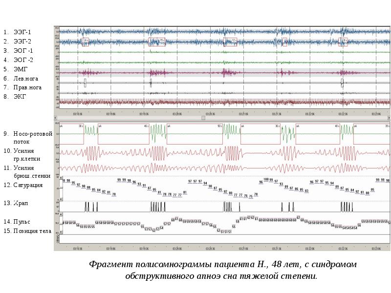 ЭЭГ-1
ЭЭГ-1
ЭЭГ-2
ЭОГ -1
ЭОГ -2
ЭМГ
Лев.нога
Прав.нога
ЭКГ
ЭЭГ-1
ЭЭГ-1
ЭЭГ-2
ЭОГ -1
ЭОГ -2
ЭМГ
Лев.нога
Прав.нога
ЭКГ
