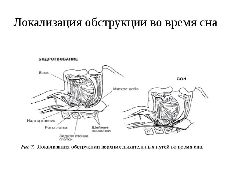 Локализация обструкции во время сна Локализация обструкции во время сна