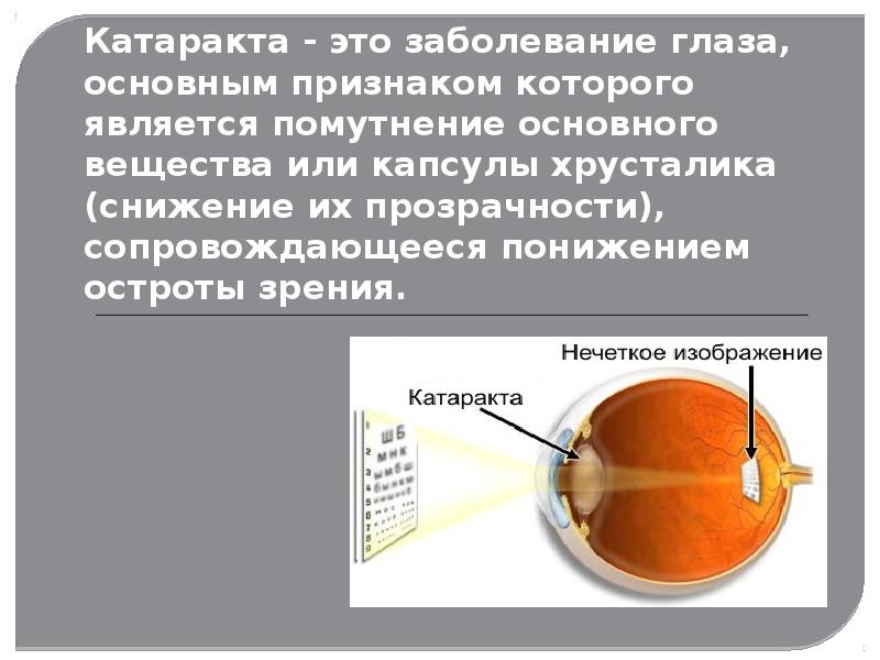 Презентация на тему катаракта