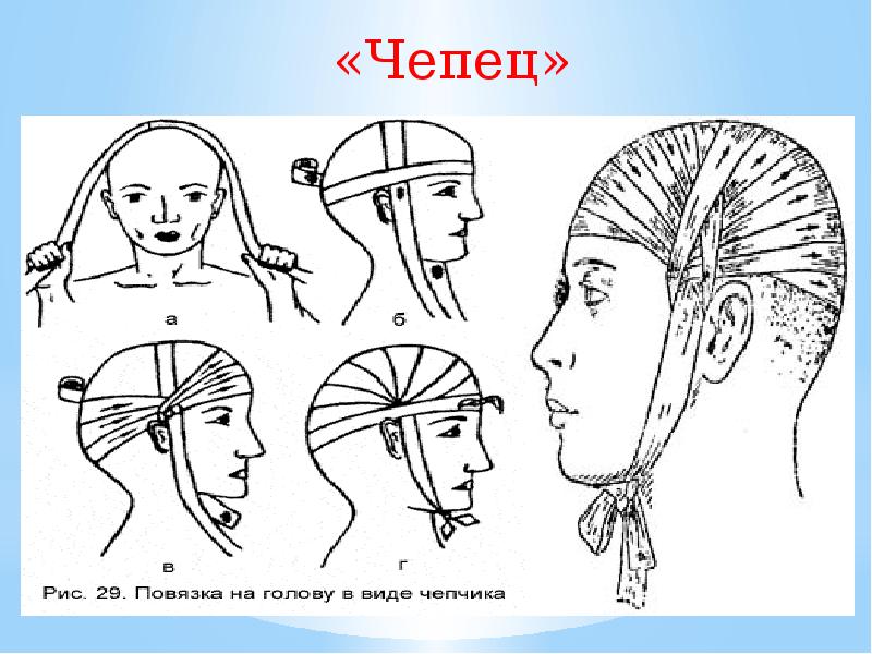 Повязка чепец. Чепец десмургия алгоритм. Повязка чепец техника наложения. Бинтование головы чепец. Схема бинтования чепец.