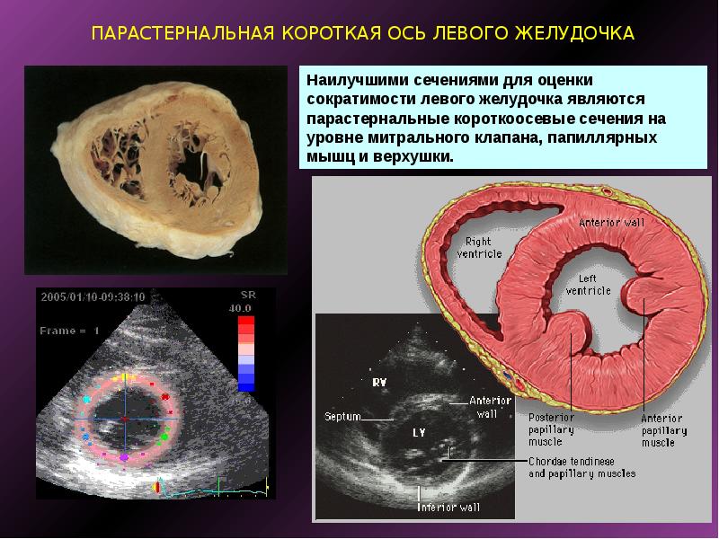 Короткая ось левого желудочка. Парастернально короткая ось. Папиллярные мышцы левого желудочка на ЭХОКГ. Папиллярные мышцы левого желудочка.