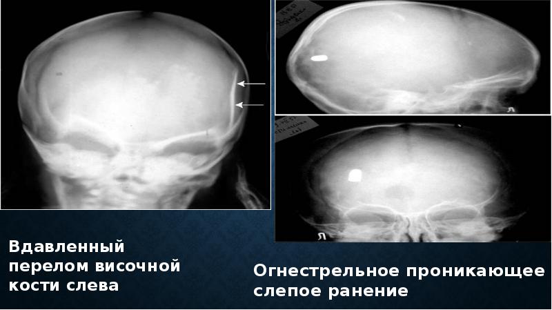 Перелом лобной кости фото РЕНТГЕНОЛОГИЧЕСКОЕ ИССЛЕДОВАНИЕ КОСТЕЙ И СУСТАВОВ ДАГЕСТАНСКИЙ ГОСУДАРСТВЕННЫЙ