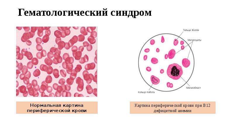 B12 анемия презентация