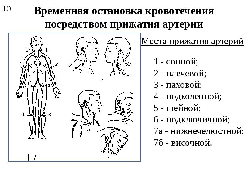 Сколько основных точек прижатия артерий. Остановка кровотечения на прижатием сонной артерии. Пальцевое прижатие артерии к кости. Пальцевое прижатие артерий при кровотечениях таблица. Пальцевое прижатие общей сонной артерии топография.