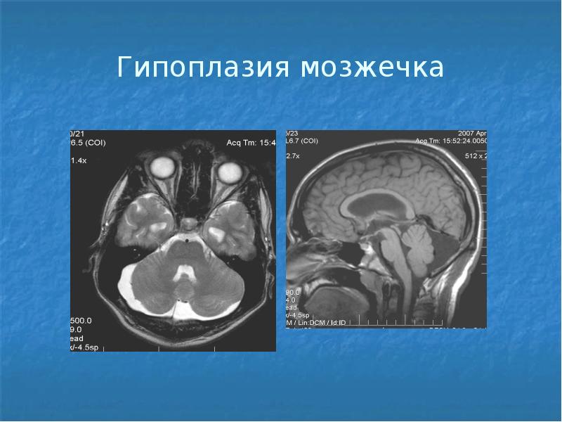 Гипоплазия правой головного мозга. Гипоплазия миндаликов мозжечка. Гипоплазия червя мозжечка у ребенка кт. Агенезия червя мозжечка у ребенка. Гипоплазия полушария мозжечка.