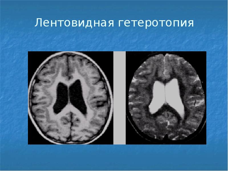 Шизэнцефалия мрт картинки