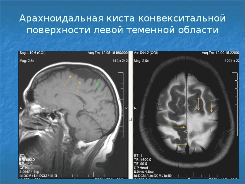 Мр картина неравномерного расширения субарахноидальных конвекситальных пространств