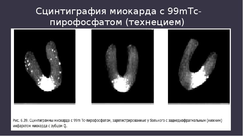 Презентация сцинтиграфия миокарда