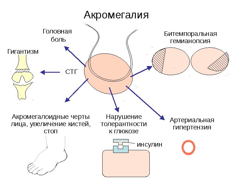 Заболевания гипофиза презентация