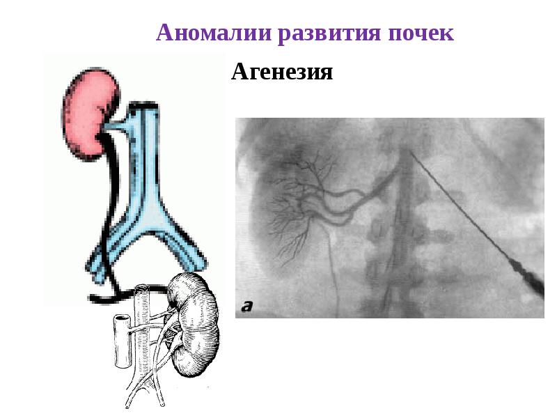 Аномалии мочеполовой системы презентация