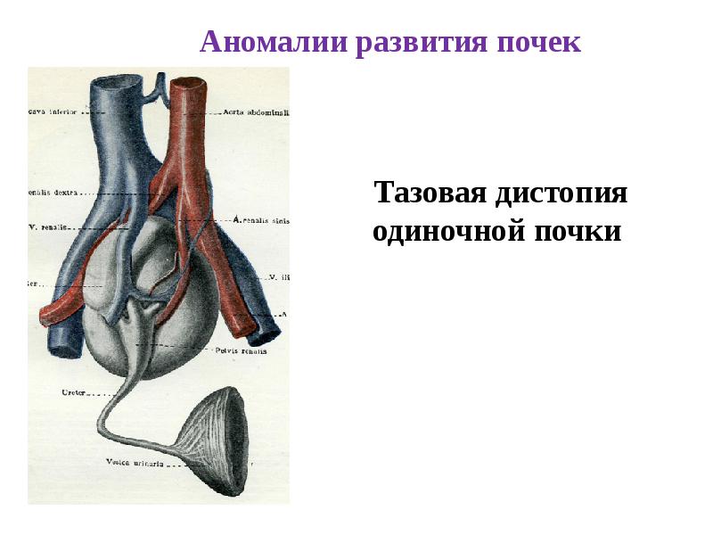 Аномалии мочеполовой системы презентация