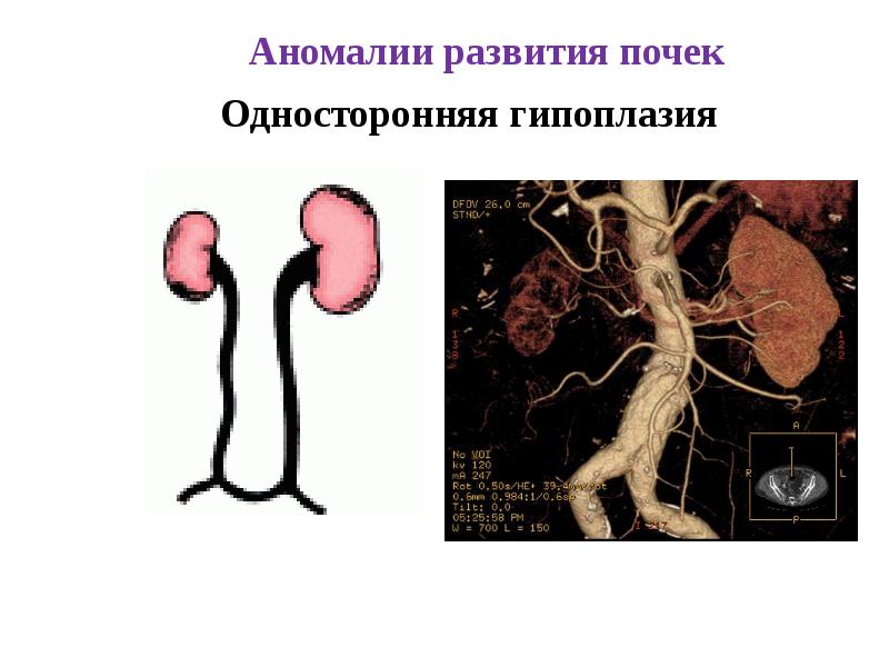 Аномалии мочеполовой системы презентация