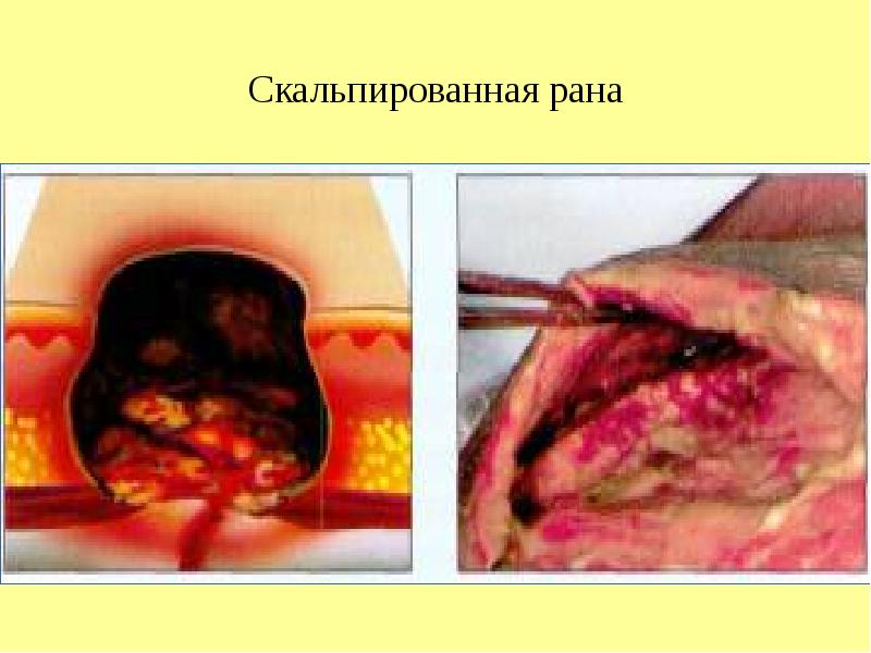Скальпированная рана