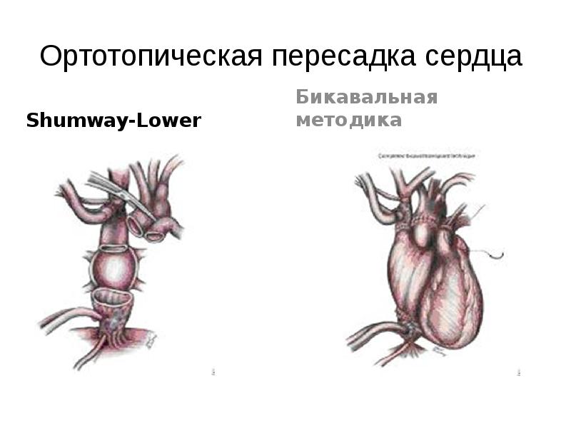 Трансплантация сердца презентация