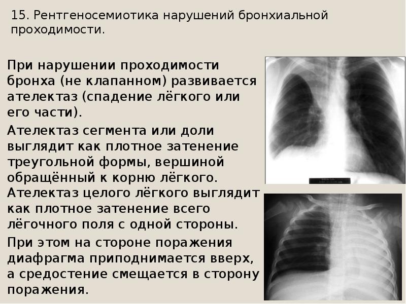 Видно ли коклюш на рентгене