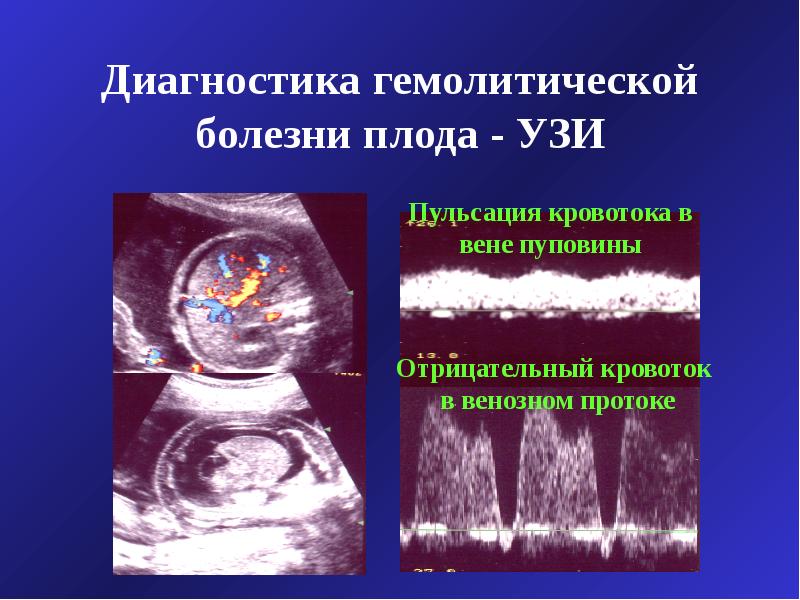 Гемолитическая болезнь новорожденных педиатрия презентация