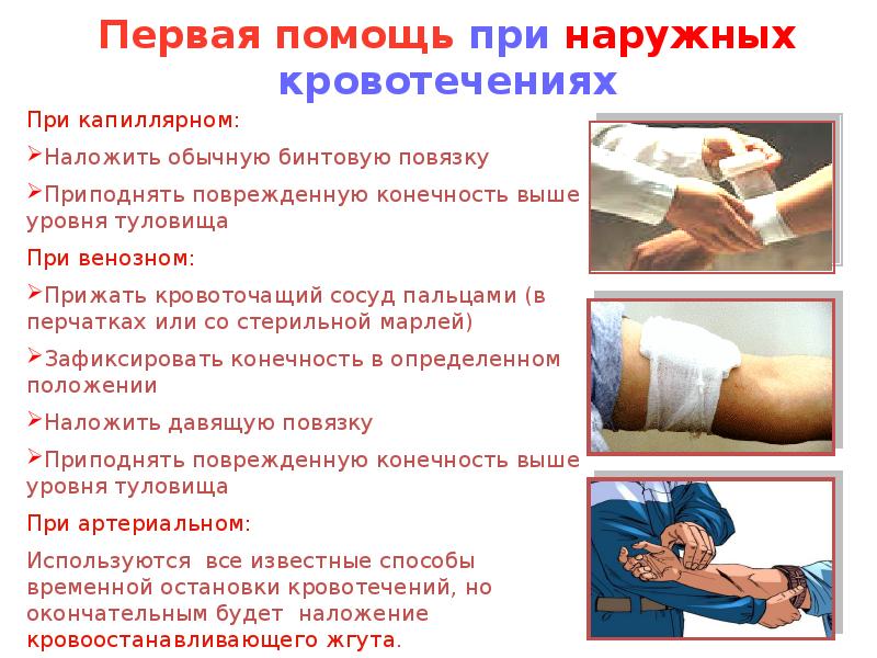 первая помощь при наружных. последовательные этапы первой помощи при наружном кровотечении. этапы оказания первой помощи при наружных кровотечениях. оказание первой помощи при наружном и внутреннем кровотечении. первая помощь при кровотечениях.