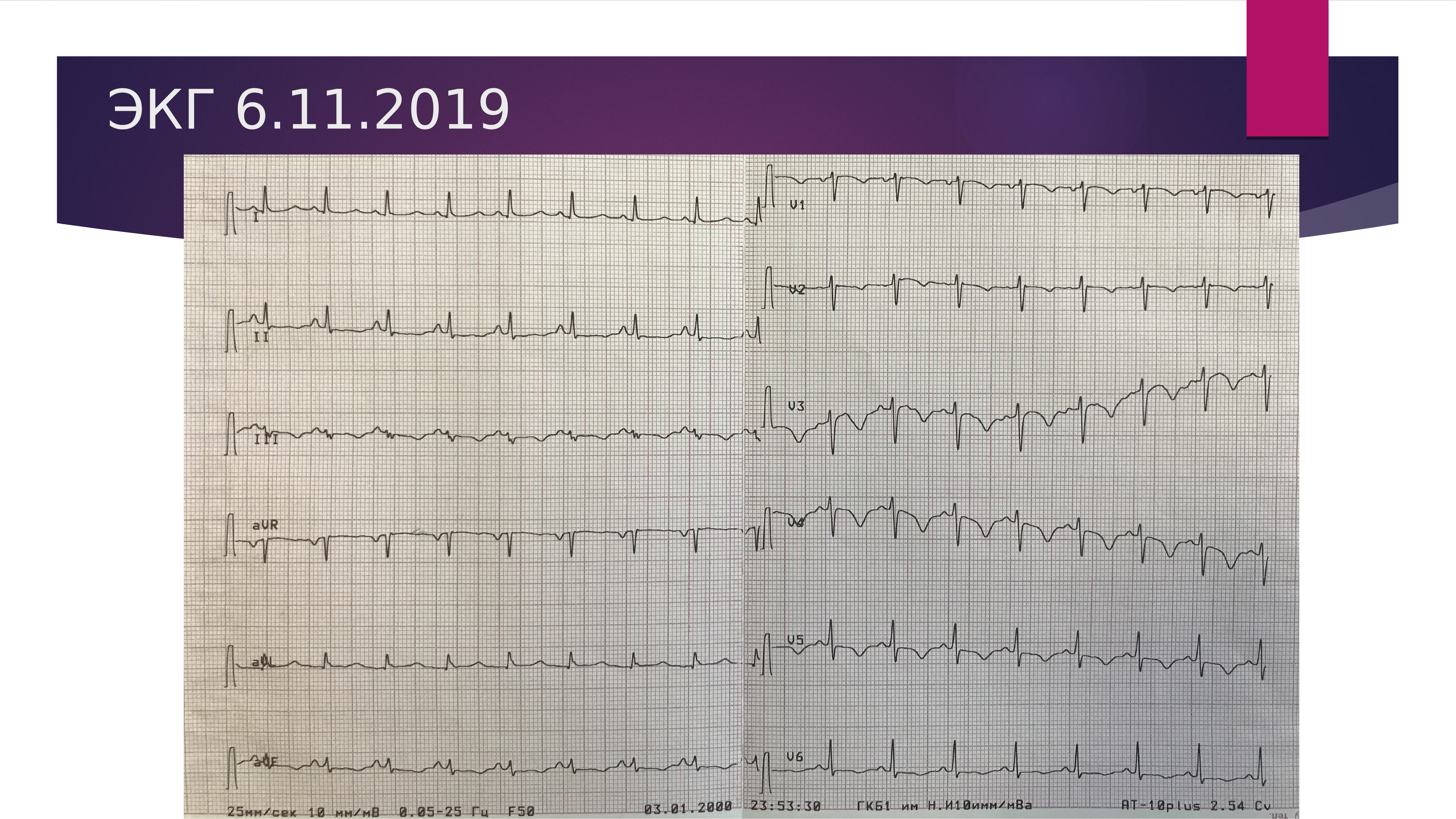 Экг 6 3. ЭКГ 6. ЭКГ 06.05.2000. R6 > r5 > r4 ЭКГ. ТСС 6 Б на ЭКГ.
